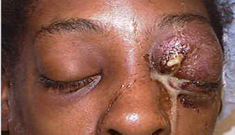 Orbital infection &mdash; clinical photograph showing severe proptosis and periorbital swelling